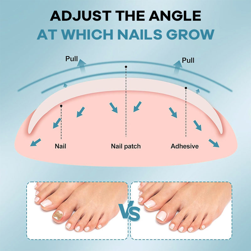 Ingrown Nail Filling Pad & Nail Groove Patch